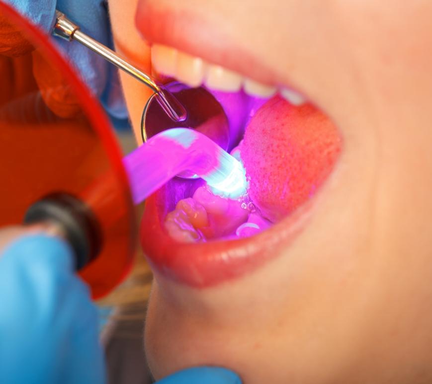 Close up of dental patient getting direct bonding on a front tooth
