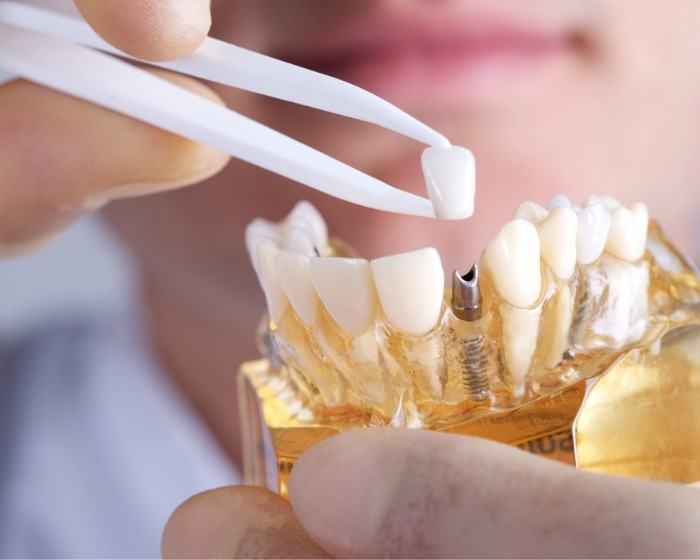 Dentist placing a dental crown on a model of dental implants