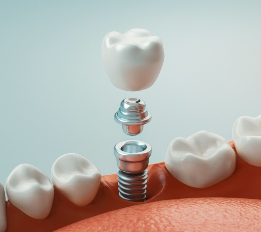 Illustrated dental implant with abutment and crown