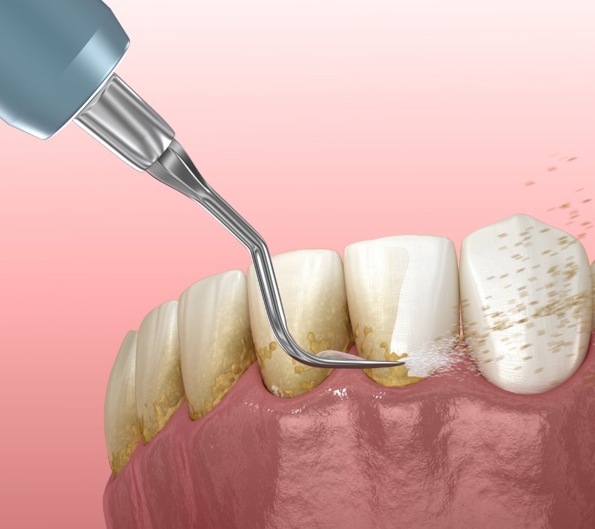 Illustrated dental scaler removing plaque buildup from teeth