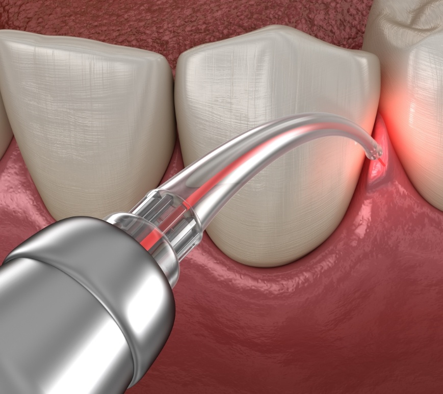 Illustrated dental laser treating gum disease