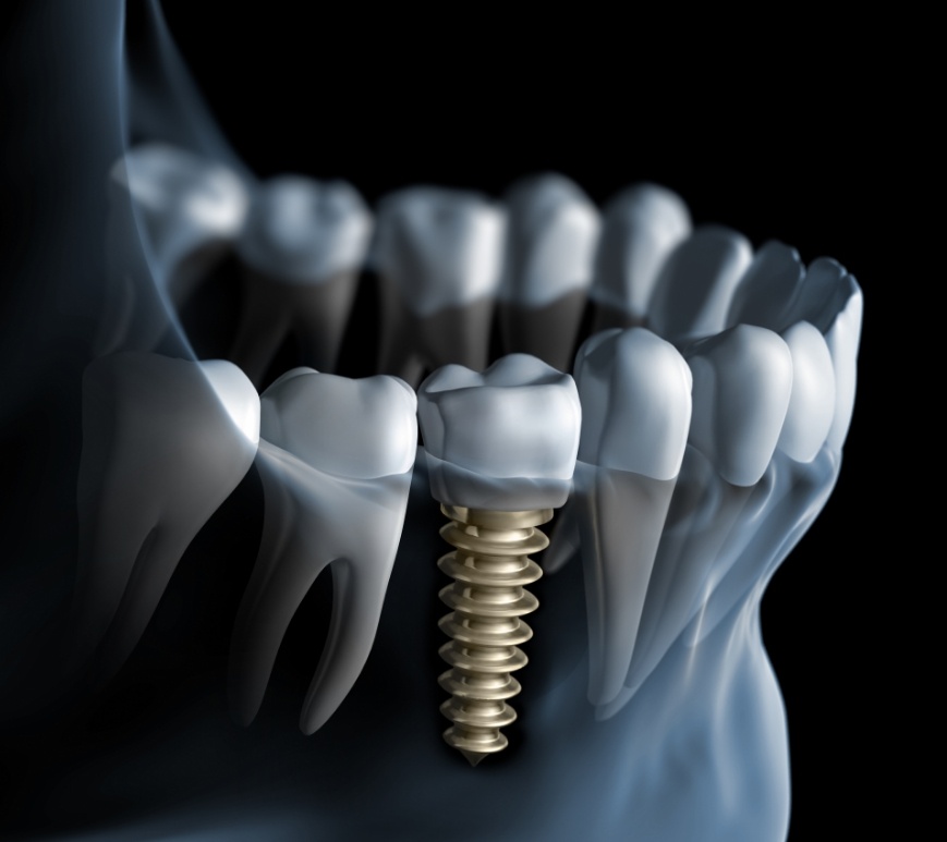 Illustrated X ray of a person with a dental implant replacing a missing tooth