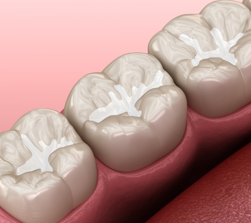 Illustrated row of teeth with white fillings