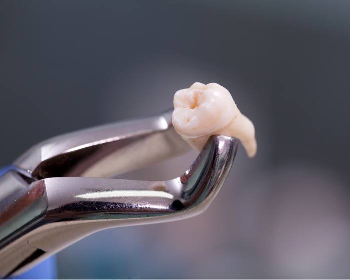 Dental forceps holding an extracted tooth